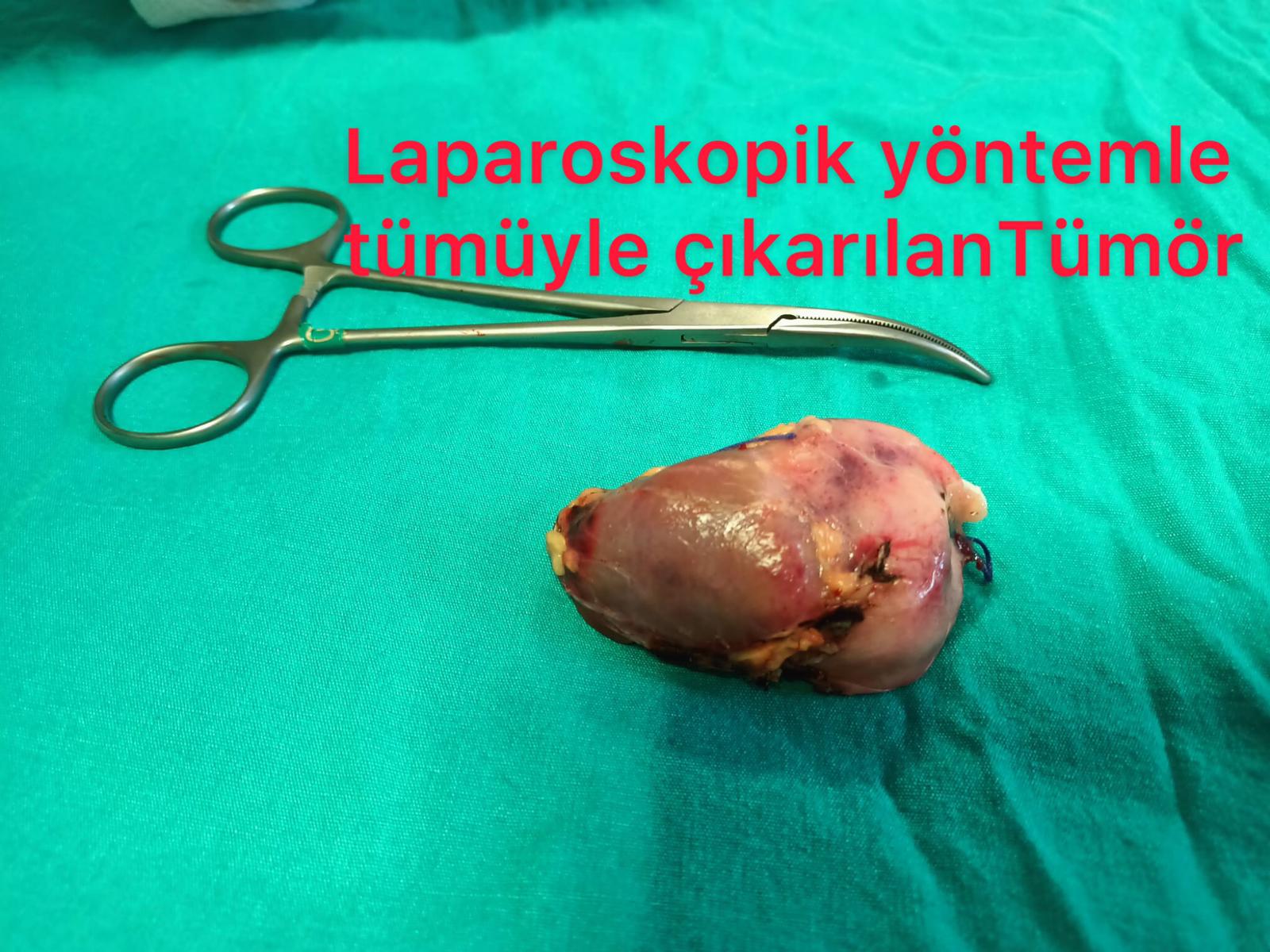 Laparoskopik yöntemle tümüyle çıkarılan tümör görseli